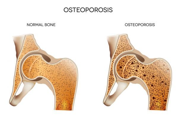 osteoporosis - causes, risk factors and natural solutions